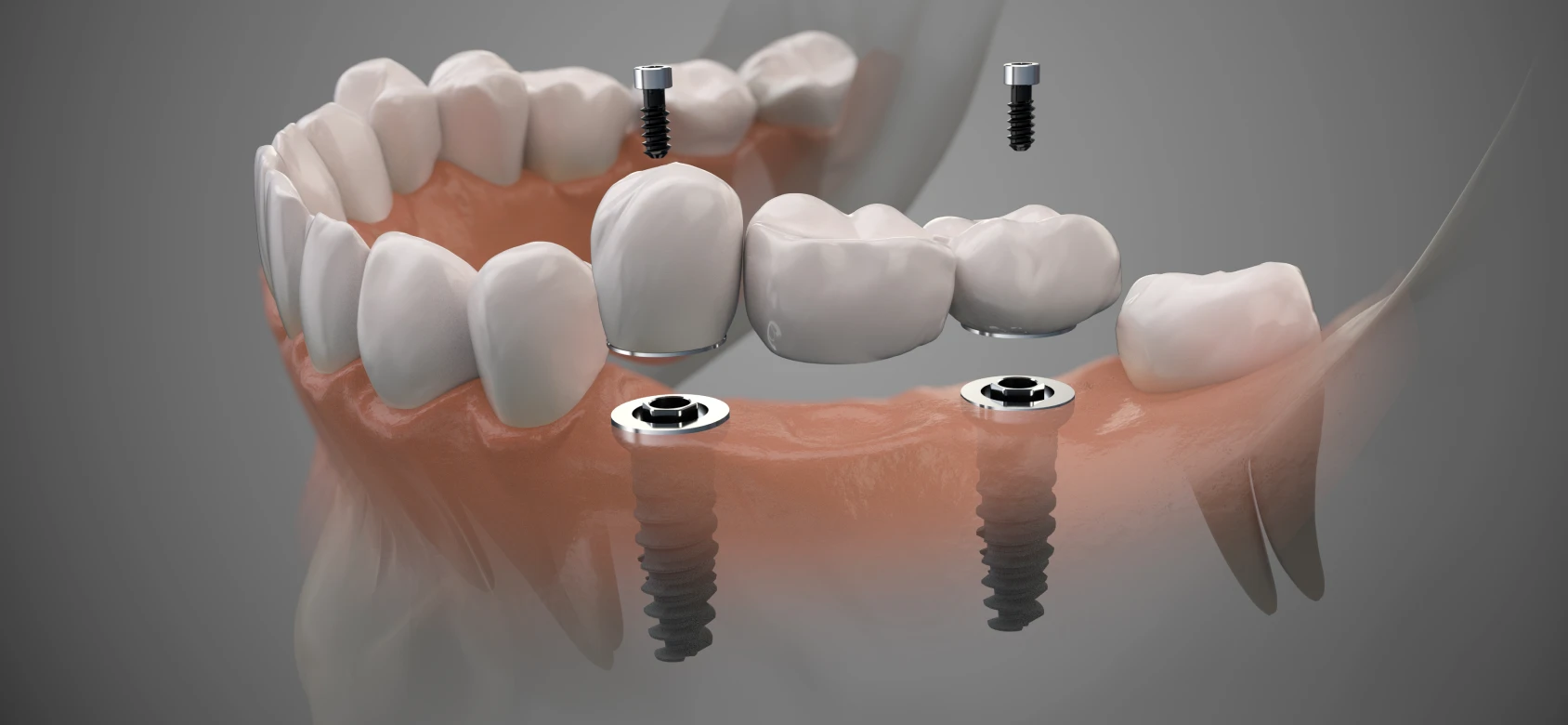 Les implants pour remplacer mes dents manquantes