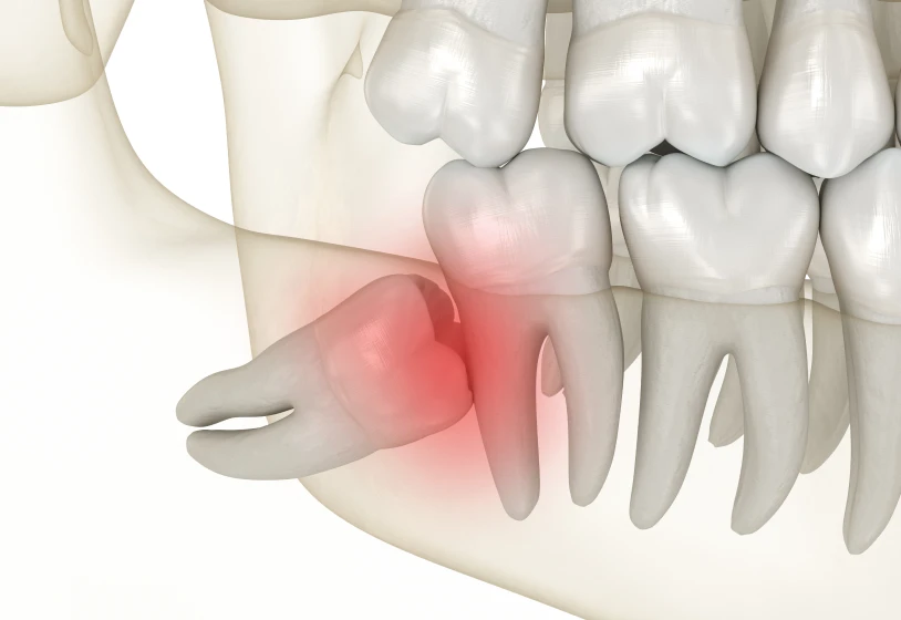 Extraction des dents de sagesse