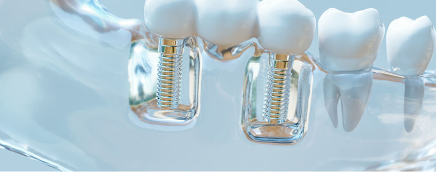 implants cabinet Claude Monet Croissy chirurgie dentaire