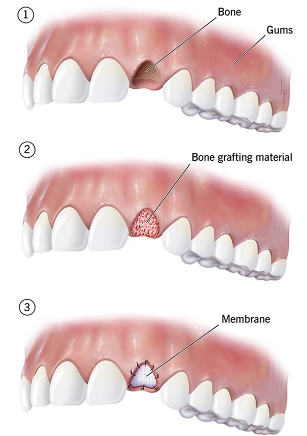 Dental bone graft