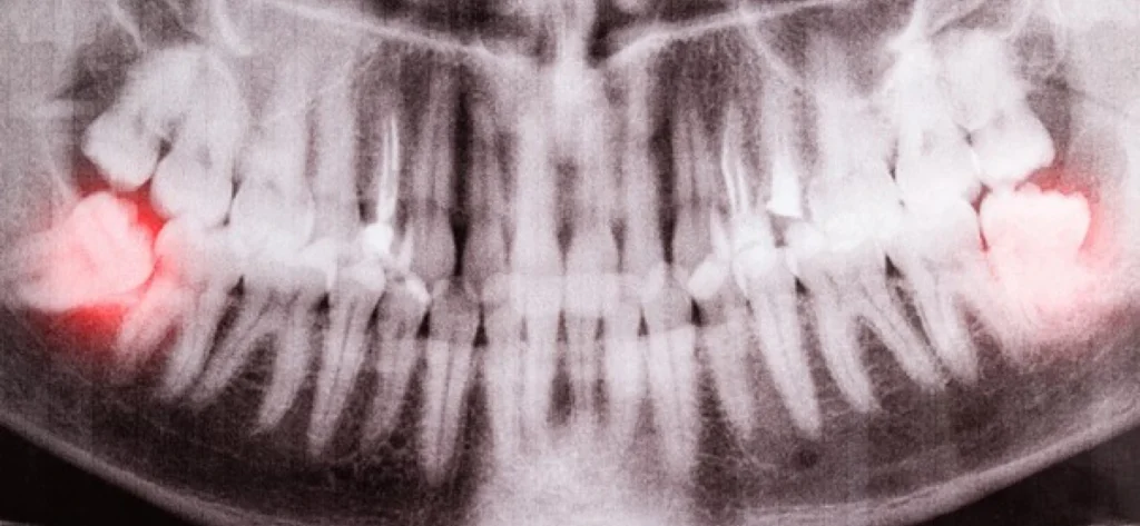Should I have my wisdom teeth taken out? 