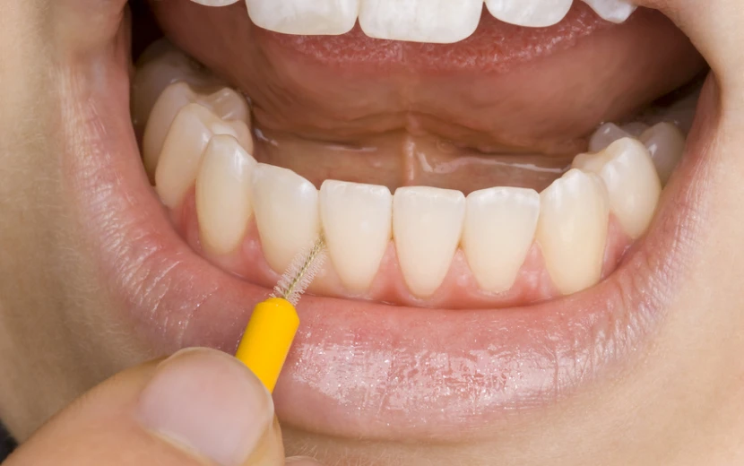 Remodelage des gencives