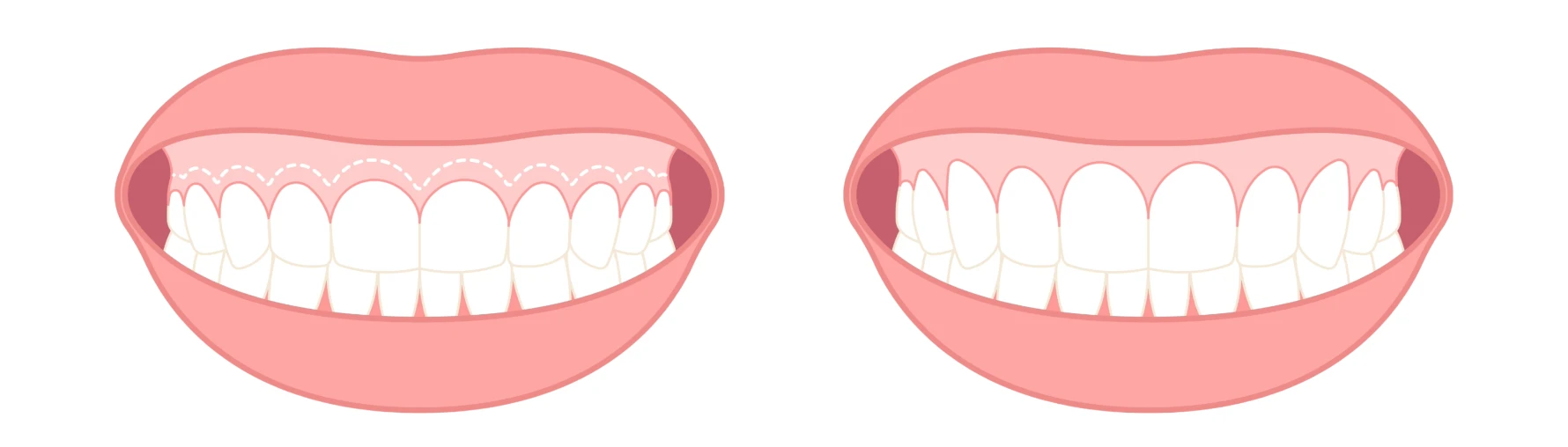 Remodelage des gencives