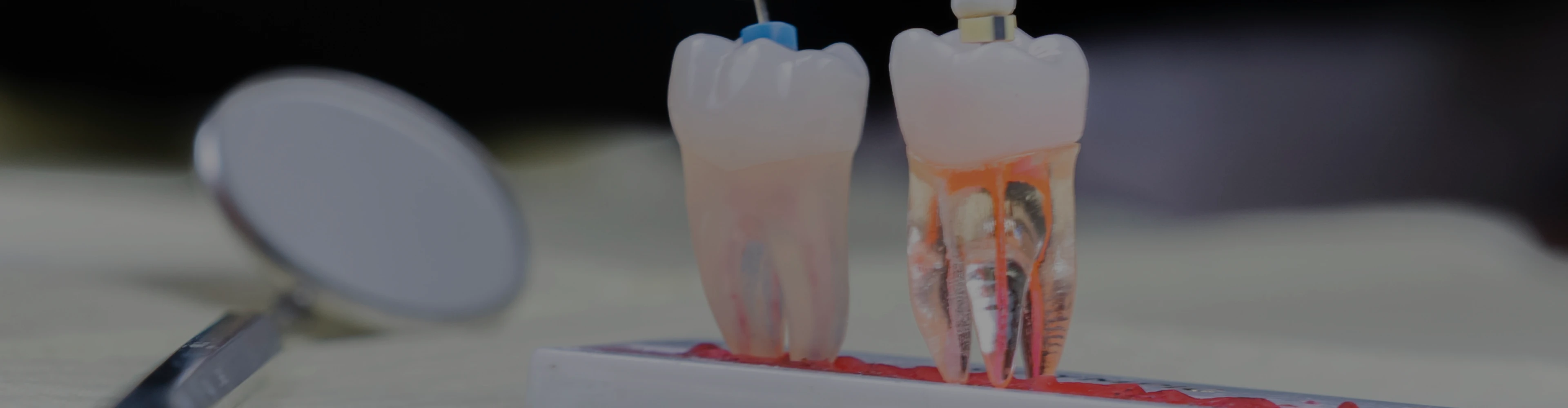 endodontie-dentiste-croissy-sur-seine