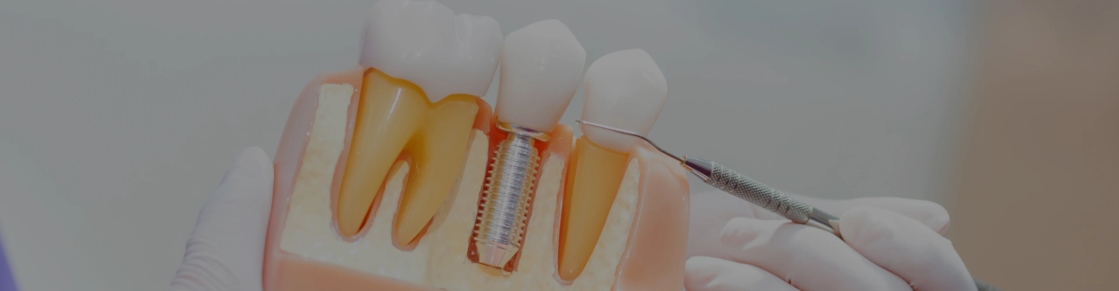 implant-dentaire-unitaire-croissy